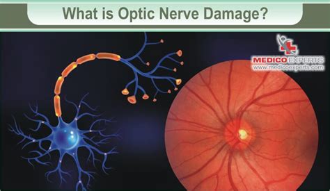 can optic nerve damage be detected